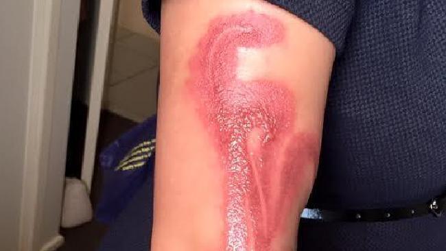 iPhone 7 又出事　燒傷熟睡澳洲孕婦