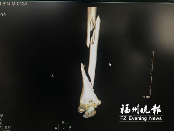 中國少年為拍攝抖音影片　伸手進洗衣機造成嚴重骨折