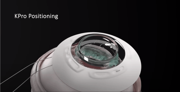 以色列人造眼角膜移植成功【有片睇】78 歲盲人恢復視力