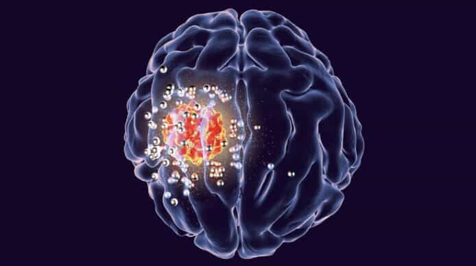 無線裝置植入頭顱骨治腦癌    老鼠實驗成功令存活時間增 3 倍