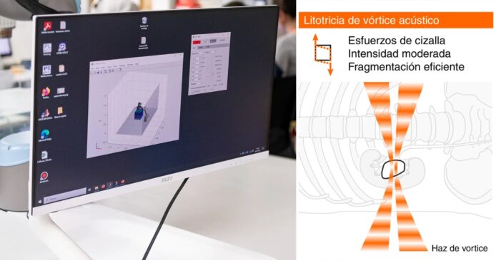 全新漩渦聲波打碎腎結石    非侵入性腎石治療有新法