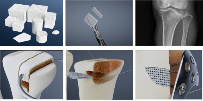 中大研發含鎂可降解骨修復材料獲准臨床應用